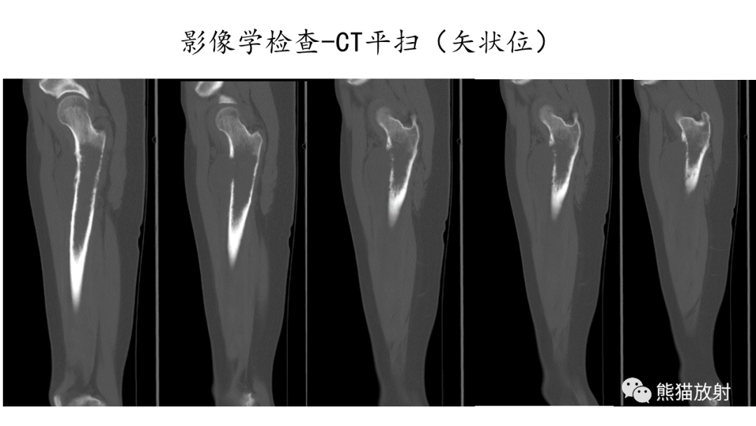 影像PPT - 【病例】股骨纤维肉瘤 VS 胸骨浆细胞瘤-5