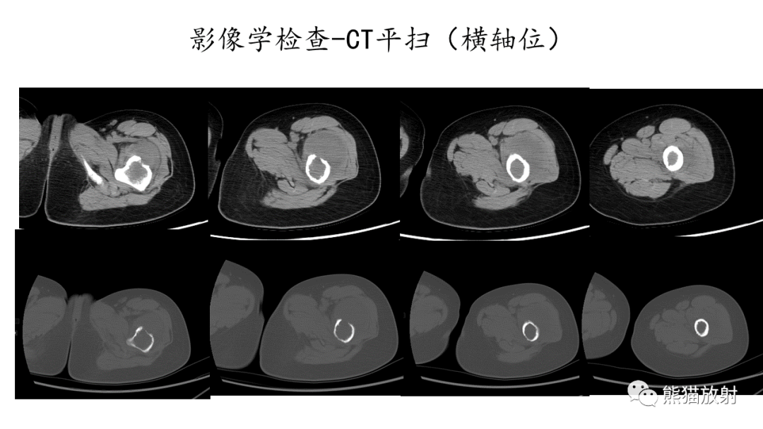 影像PPT - 【病例】股骨纤维肉瘤 VS 胸骨浆细胞瘤-4