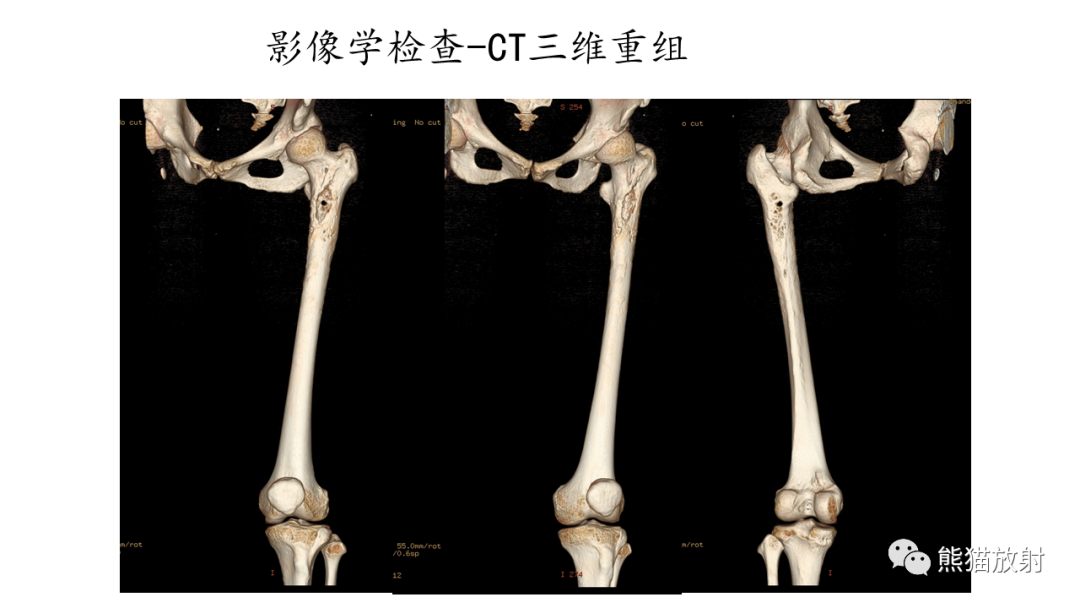 影像PPT - 【病例】股骨纤维肉瘤 VS 胸骨浆细胞瘤-7