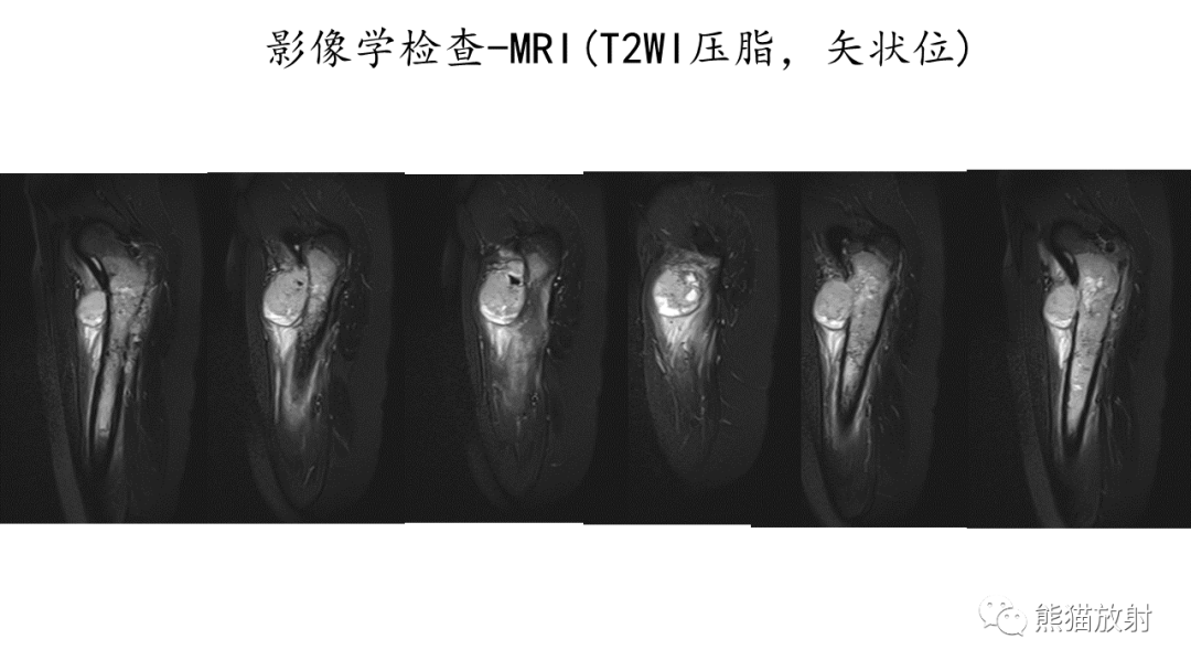 影像PPT - 【病例】股骨纤维肉瘤 VS 胸骨浆细胞瘤-9