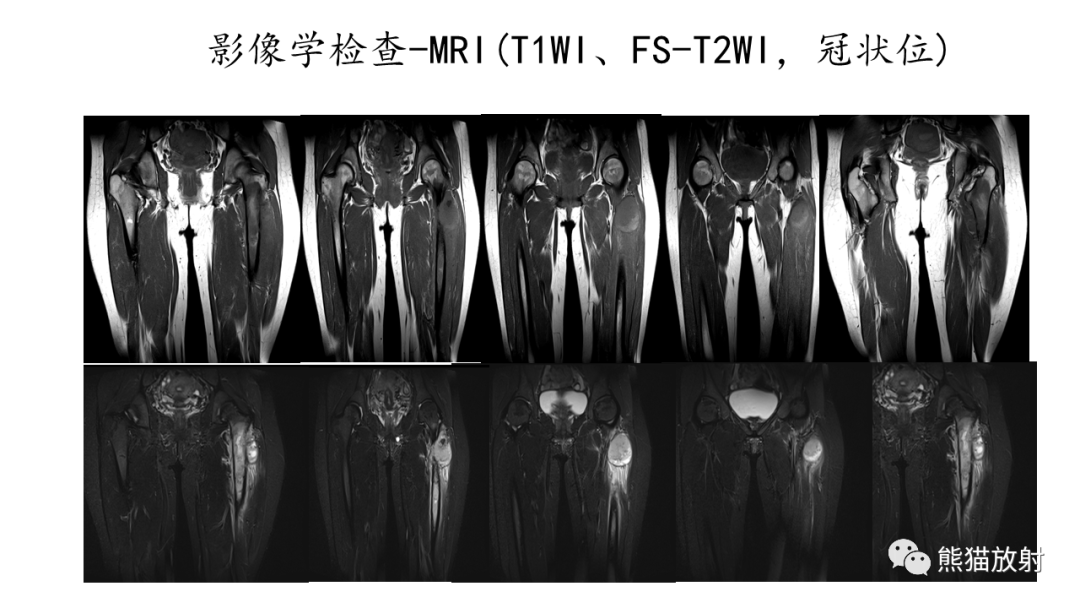 影像PPT - 【病例】股骨纤维肉瘤 VS 胸骨浆细胞瘤-10