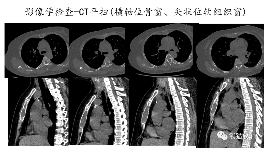 影像PPT - 【病例】股骨纤维肉瘤 VS 胸骨浆细胞瘤-15