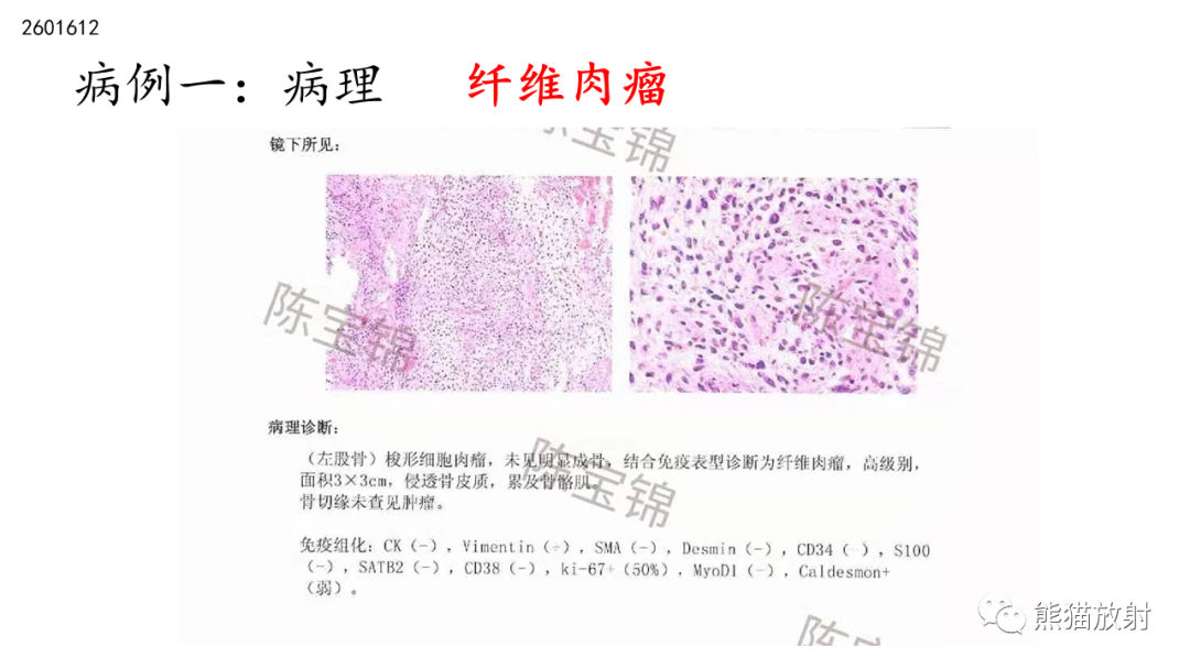 影像PPT - 【病例】股骨纤维肉瘤 VS 胸骨浆细胞瘤-21