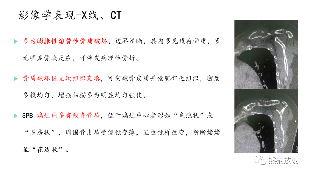 影像PPT - 【病例】股骨纤维肉瘤 VS 胸骨浆细胞瘤-26