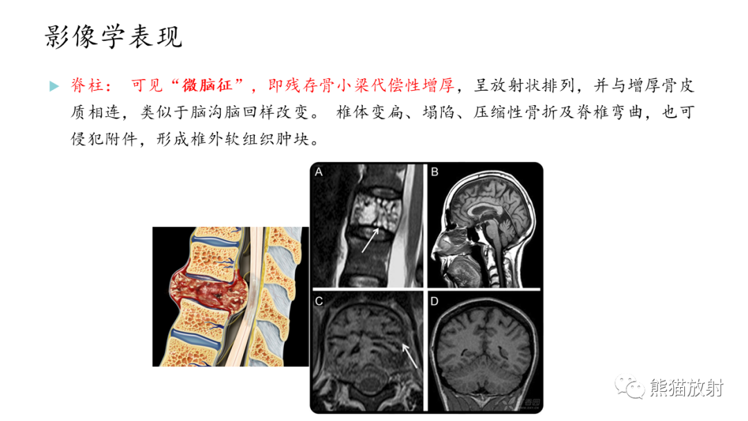 影像PPT - 【病例】股骨纤维肉瘤 VS 胸骨浆细胞瘤-28