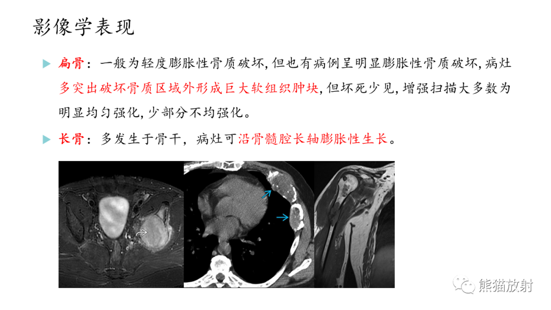 影像PPT - 【病例】股骨纤维肉瘤 VS 胸骨浆细胞瘤-29