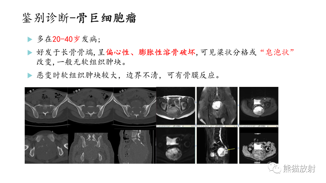 影像PPT - 【病例】股骨纤维肉瘤 VS 胸骨浆细胞瘤-30
