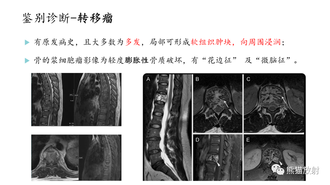 影像PPT - 【病例】股骨纤维肉瘤 VS 胸骨浆细胞瘤-33