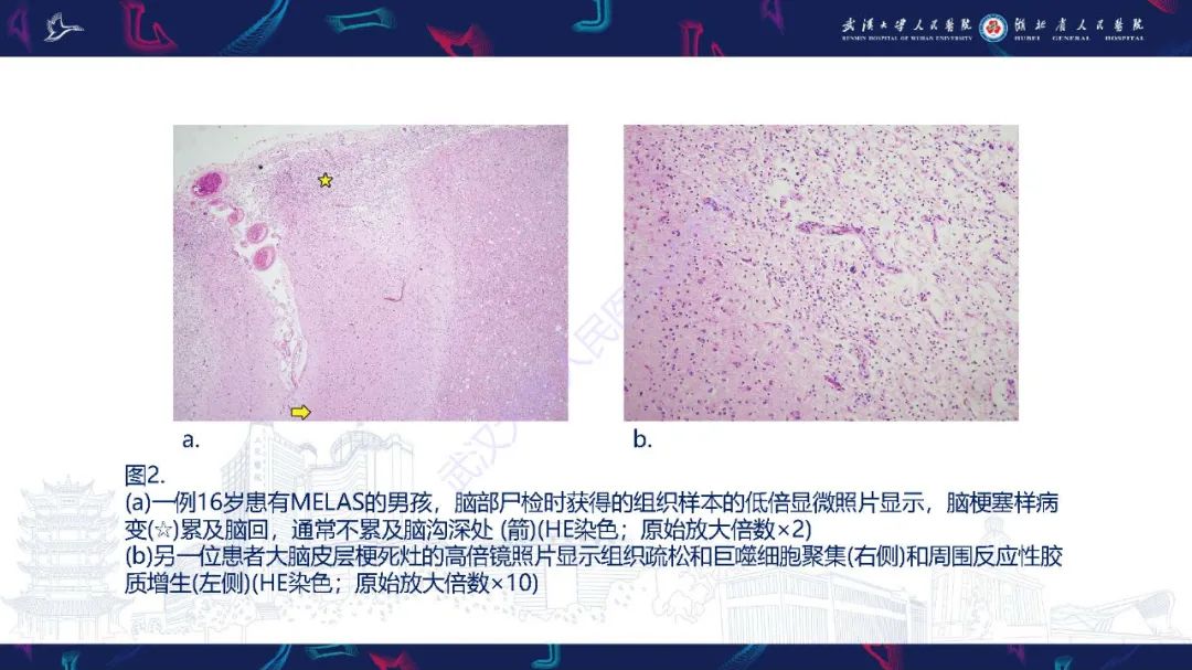 影像PPT - 【PPT】儿童中枢神经系统原发性线粒体疾病影像诊断-14