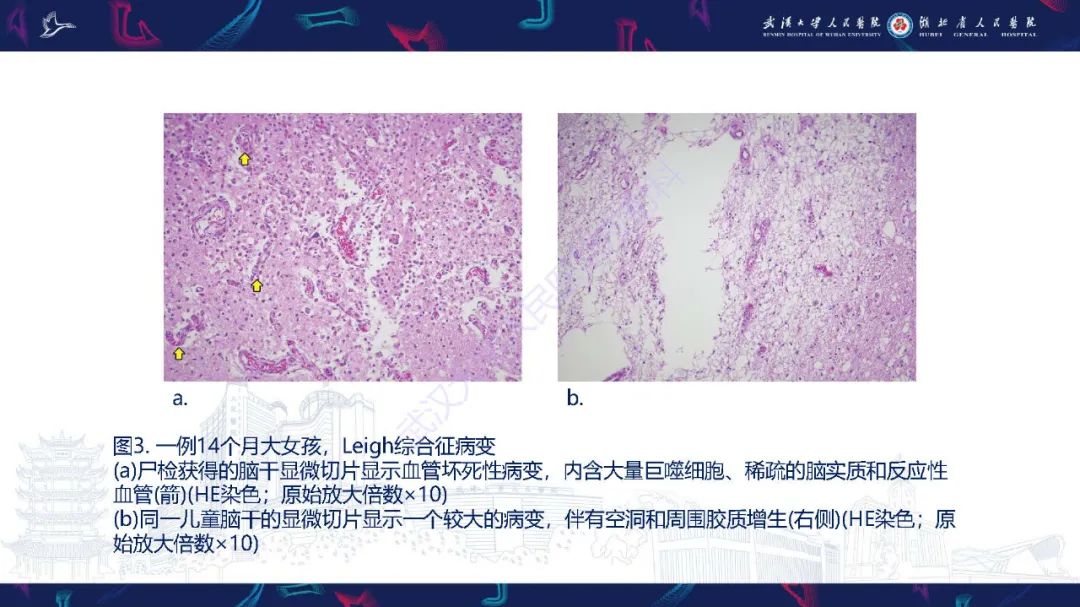 影像PPT - 【PPT】儿童中枢神经系统原发性线粒体疾病影像诊断-16