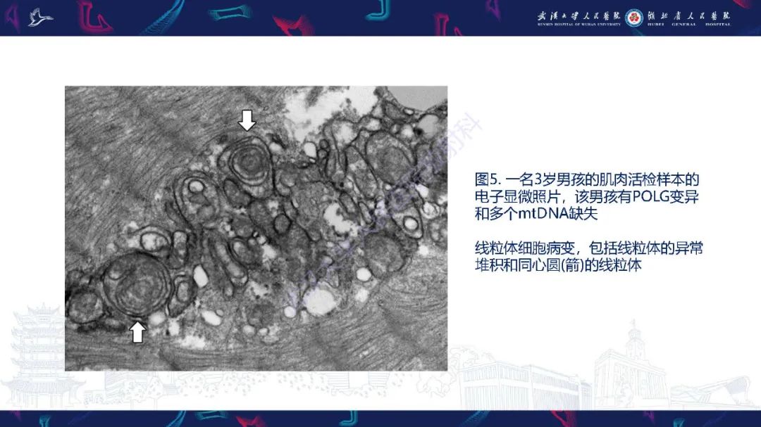 影像PPT - 【PPT】儿童中枢神经系统原发性线粒体疾病影像诊断-19
