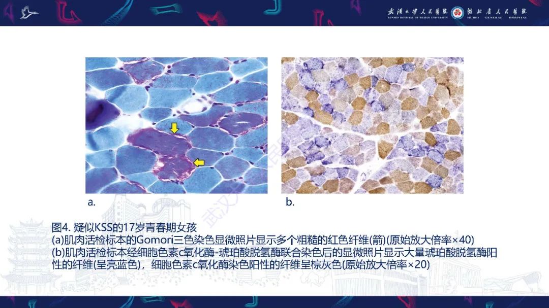 影像PPT - 【PPT】儿童中枢神经系统原发性线粒体疾病影像诊断-18