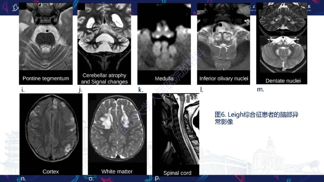 影像PPT - 【PPT】儿童中枢神经系统原发性线粒体疾病影像诊断-26