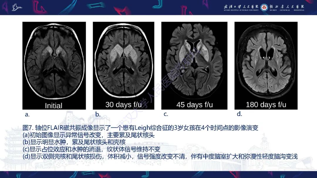 影像PPT - 【PPT】儿童中枢神经系统原发性线粒体疾病影像诊断-27