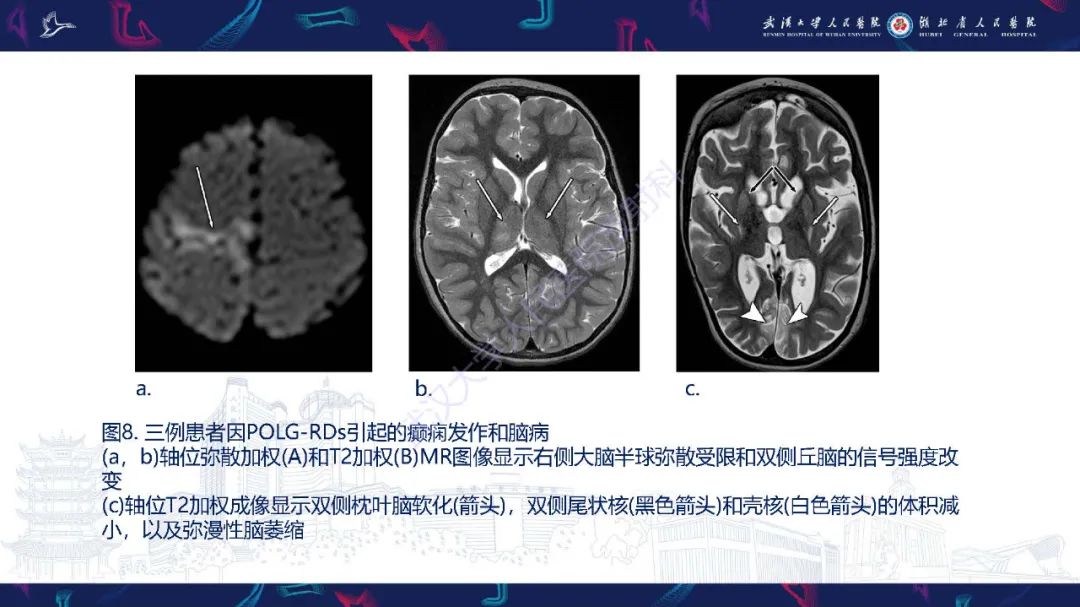 影像PPT - 【PPT】儿童中枢神经系统原发性线粒体疾病影像诊断-34