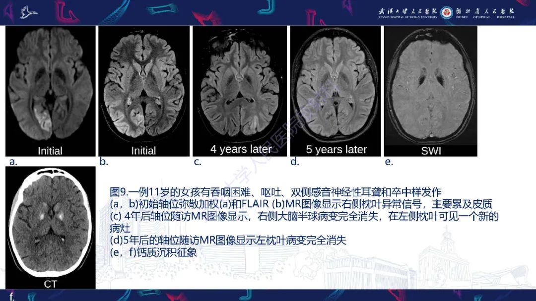 影像PPT - 【PPT】儿童中枢神经系统原发性线粒体疾病影像诊断-39
