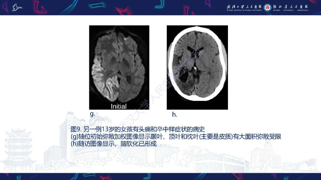 影像PPT - 【PPT】儿童中枢神经系统原发性线粒体疾病影像诊断-40