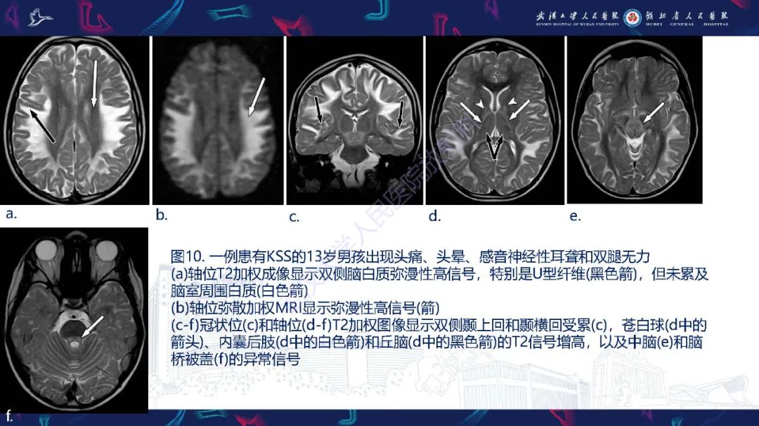 影像PPT - 【PPT】儿童中枢神经系统原发性线粒体疾病影像诊断-45