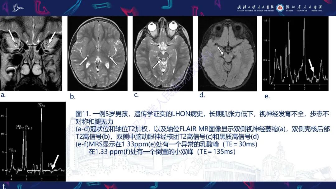 影像PPT - 【PPT】儿童中枢神经系统原发性线粒体疾病影像诊断-49