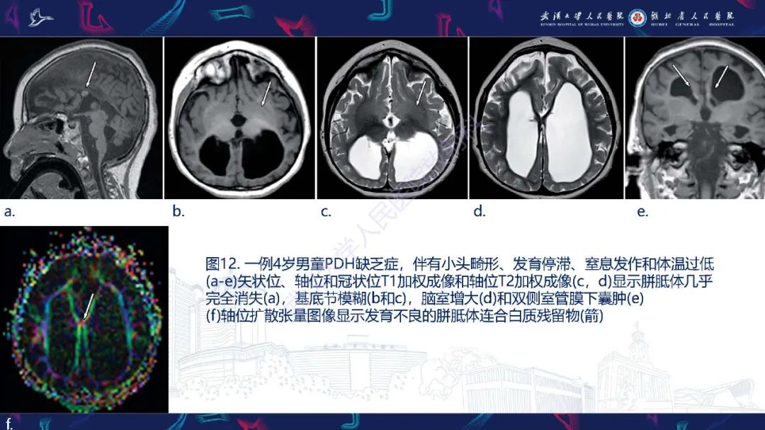 影像PPT - 【PPT】儿童中枢神经系统原发性线粒体疾病影像诊断-53