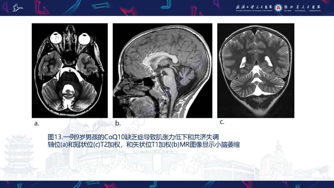 影像PPT - 【PPT】儿童中枢神经系统原发性线粒体疾病影像诊断-56