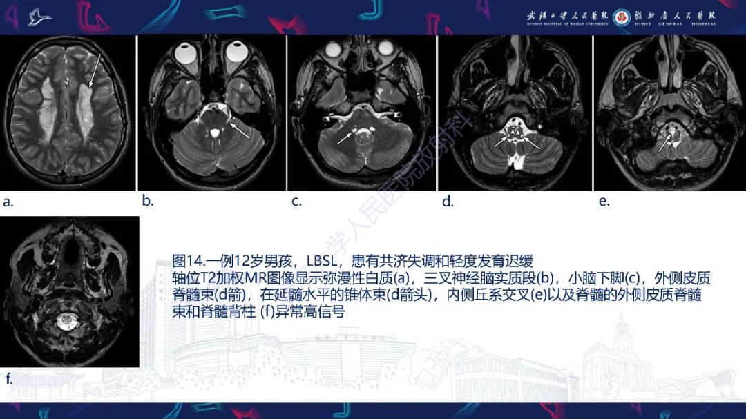 影像PPT - 【PPT】儿童中枢神经系统原发性线粒体疾病影像诊断-60