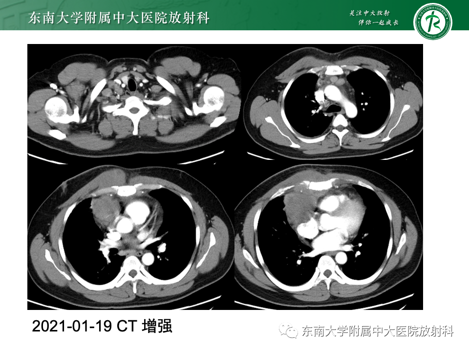 影像PPT - 【PPT】前纵隔淋巴瘤-4