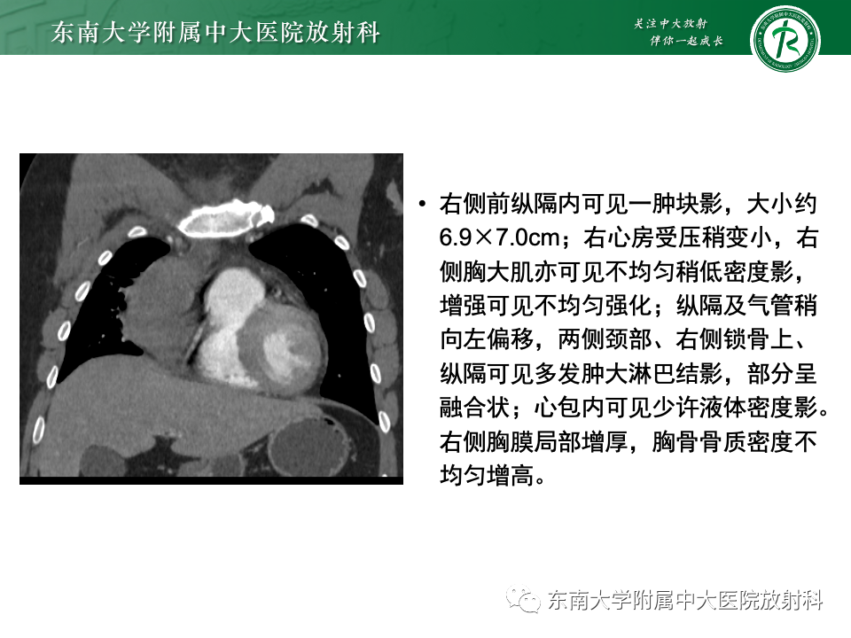 影像PPT - 【PPT】前纵隔淋巴瘤-5