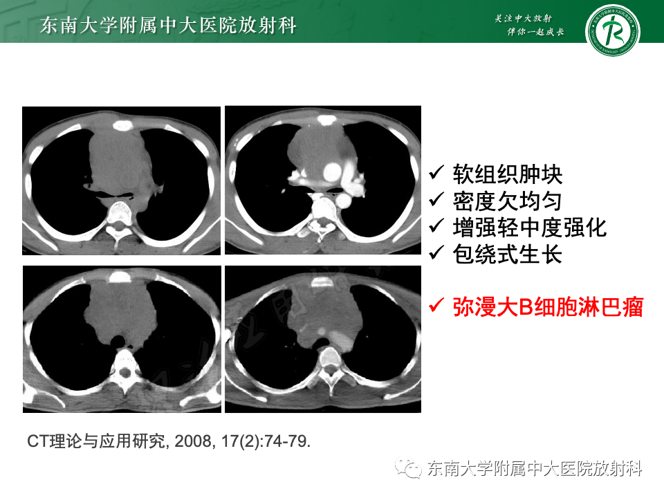 影像PPT - 【PPT】前纵隔淋巴瘤-18