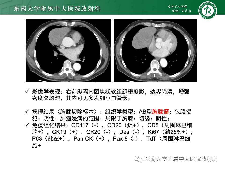 影像PPT - 【PPT】前纵隔淋巴瘤-21
