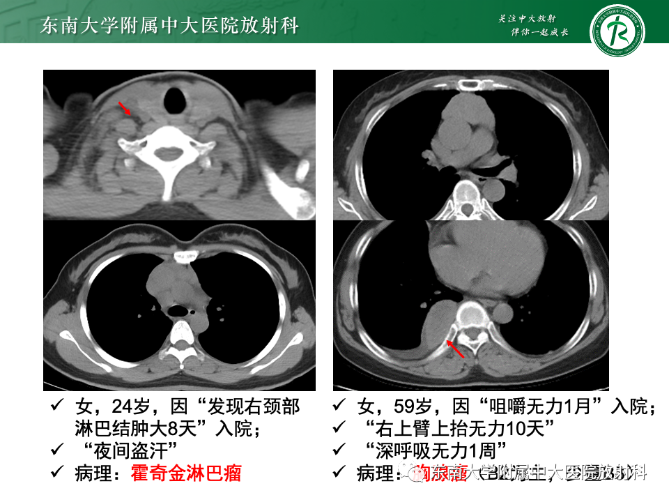 影像PPT - 【PPT】前纵隔淋巴瘤-24