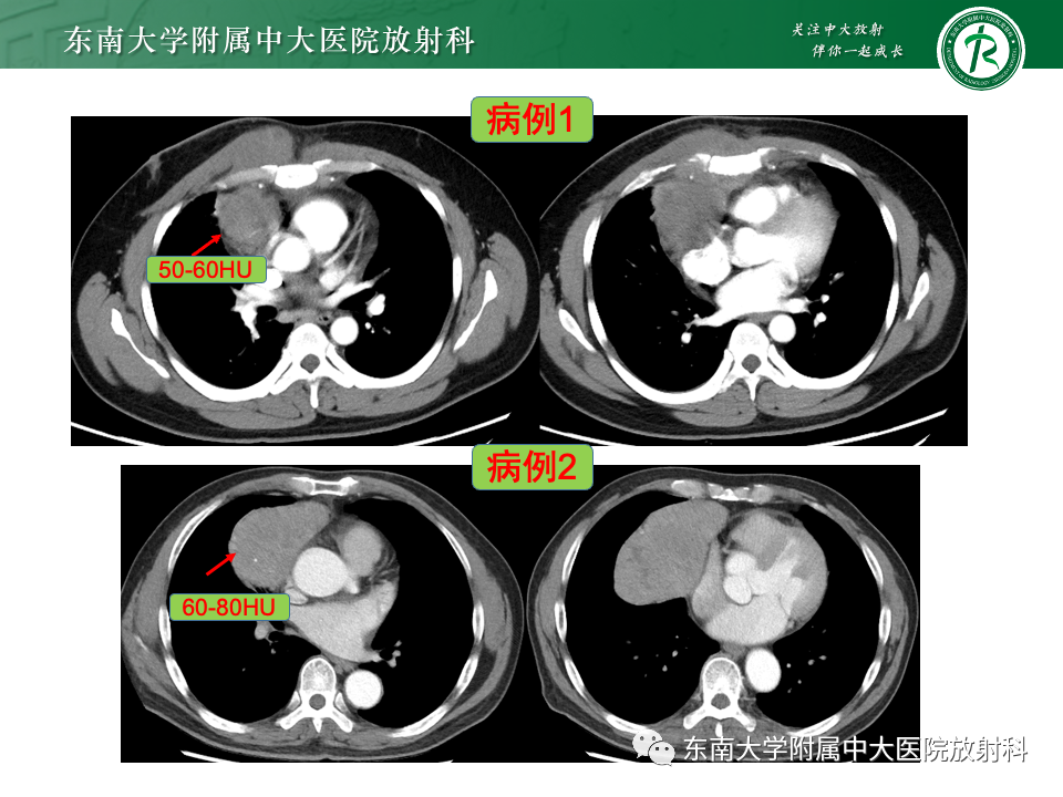 影像PPT - 【PPT】前纵隔淋巴瘤-25