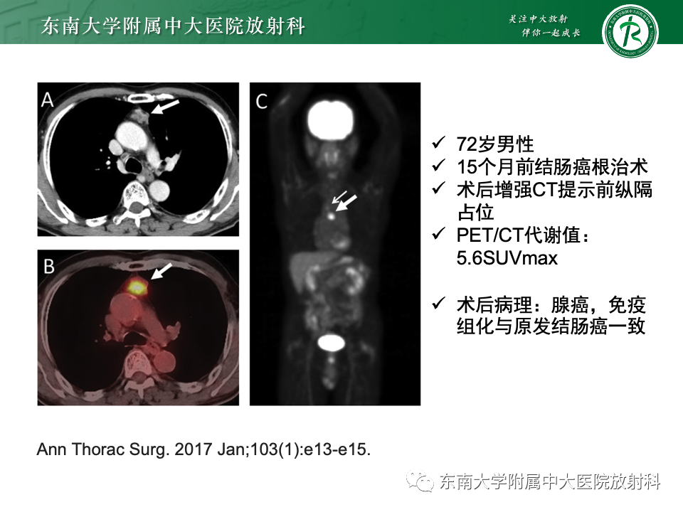 影像PPT - 【PPT】前纵隔淋巴瘤-29