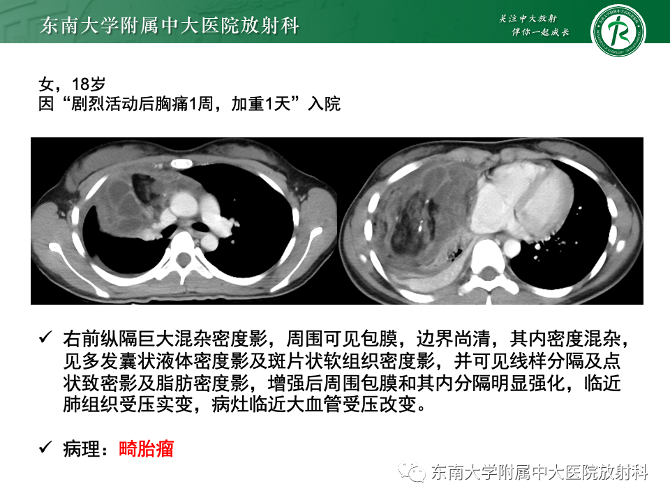 影像PPT - 【PPT】前纵隔淋巴瘤-27