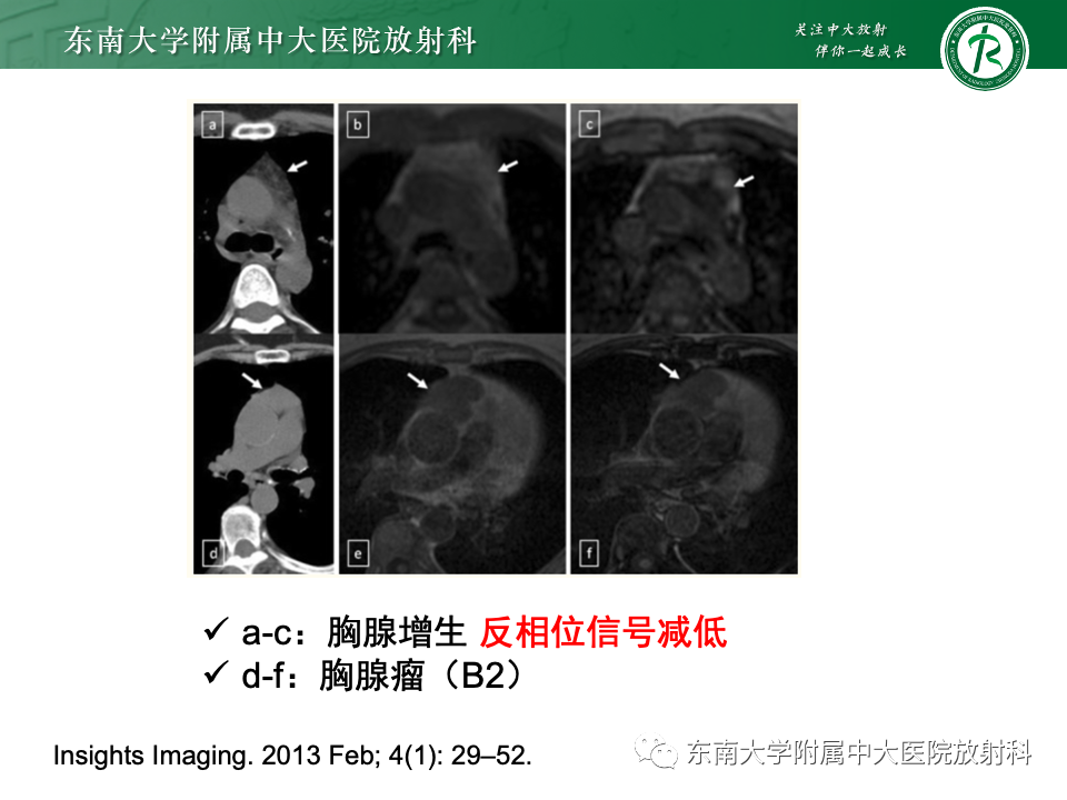影像PPT - 【PPT】前纵隔淋巴瘤-33