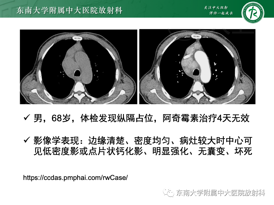 影像PPT - 【PPT】前纵隔淋巴瘤-35