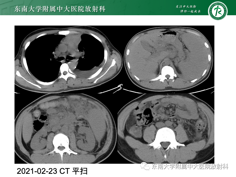 影像PPT - 【PPT】前纵隔淋巴瘤-39