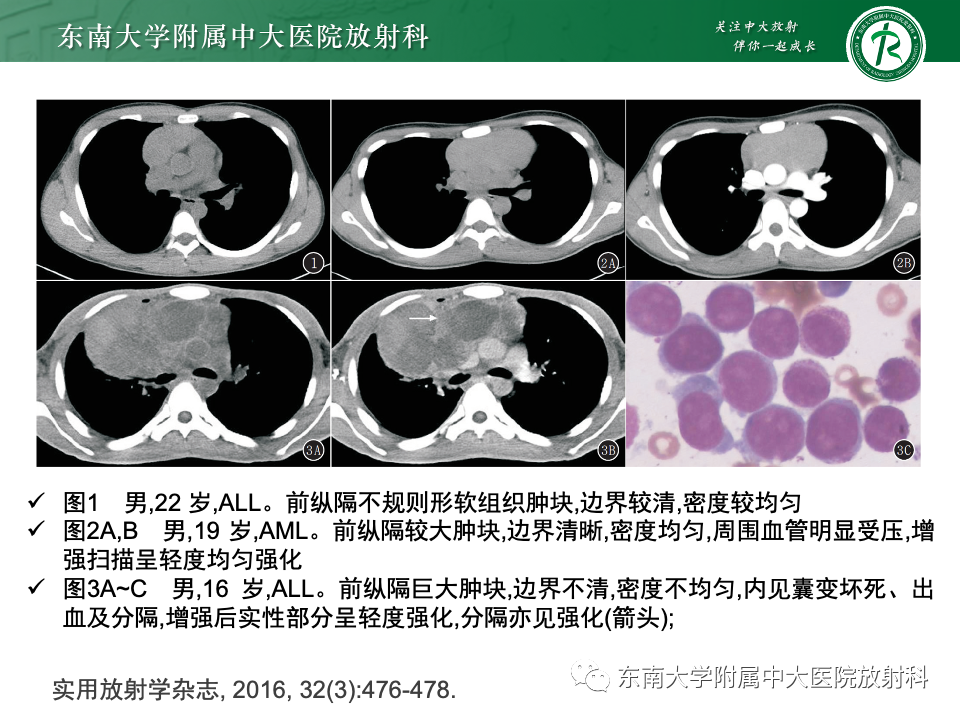 影像PPT - 【PPT】前纵隔淋巴瘤-45