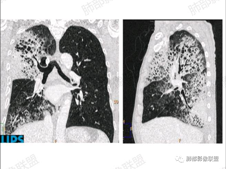 影像PPT - 【病例】单侧蜂窝肺——腺癌1例CT影像-8 影像PPT - 【病例】单侧蜂窝肺——腺癌1例CT影像-8