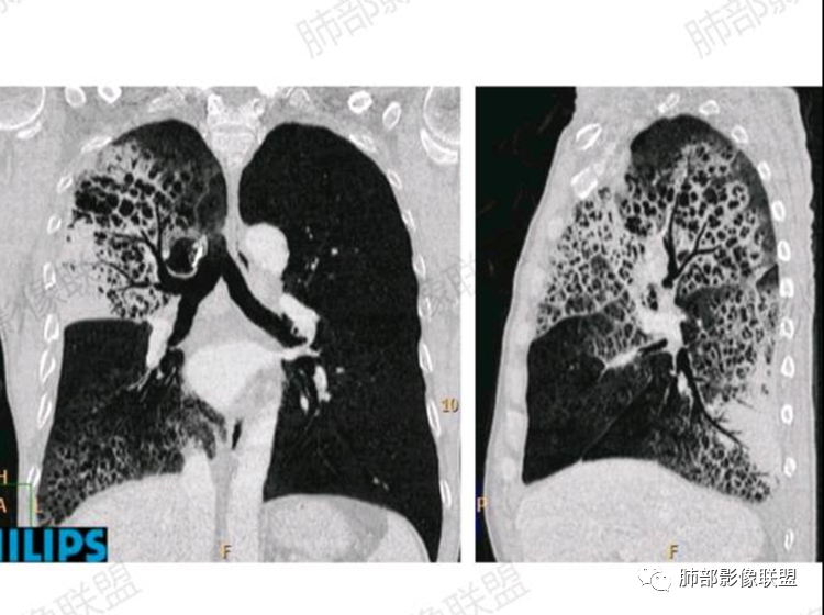 影像PPT - 【病例】单侧蜂窝肺——腺癌1例CT影像-9 影像PPT - 【病例】单侧蜂窝肺——腺癌1例CT影像-9