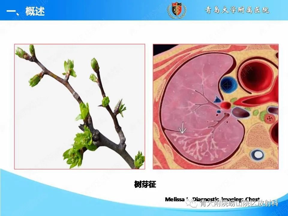 影像PPT - 【PPT】支气管黏液栓塞的影像诊断与鉴别-4