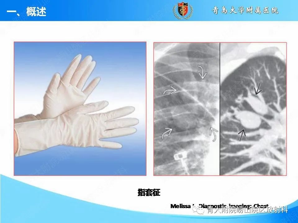 影像PPT - 【PPT】支气管黏液栓塞的影像诊断与鉴别-5