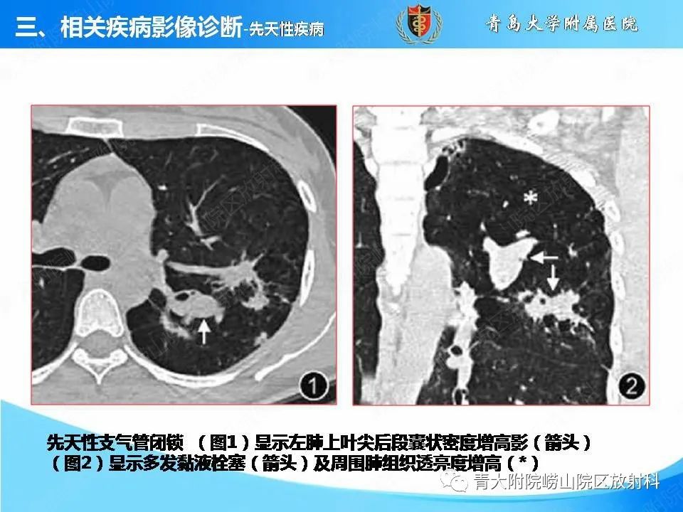 影像PPT - 【PPT】支气管黏液栓塞的影像诊断与鉴别-10