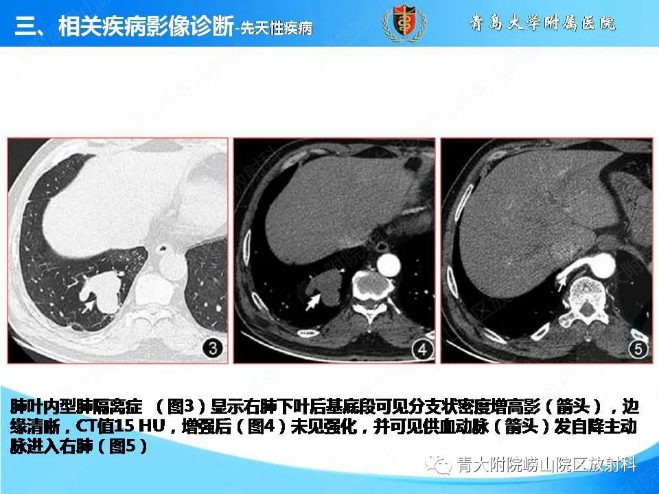 影像PPT - 【PPT】支气管黏液栓塞的影像诊断与鉴别-13