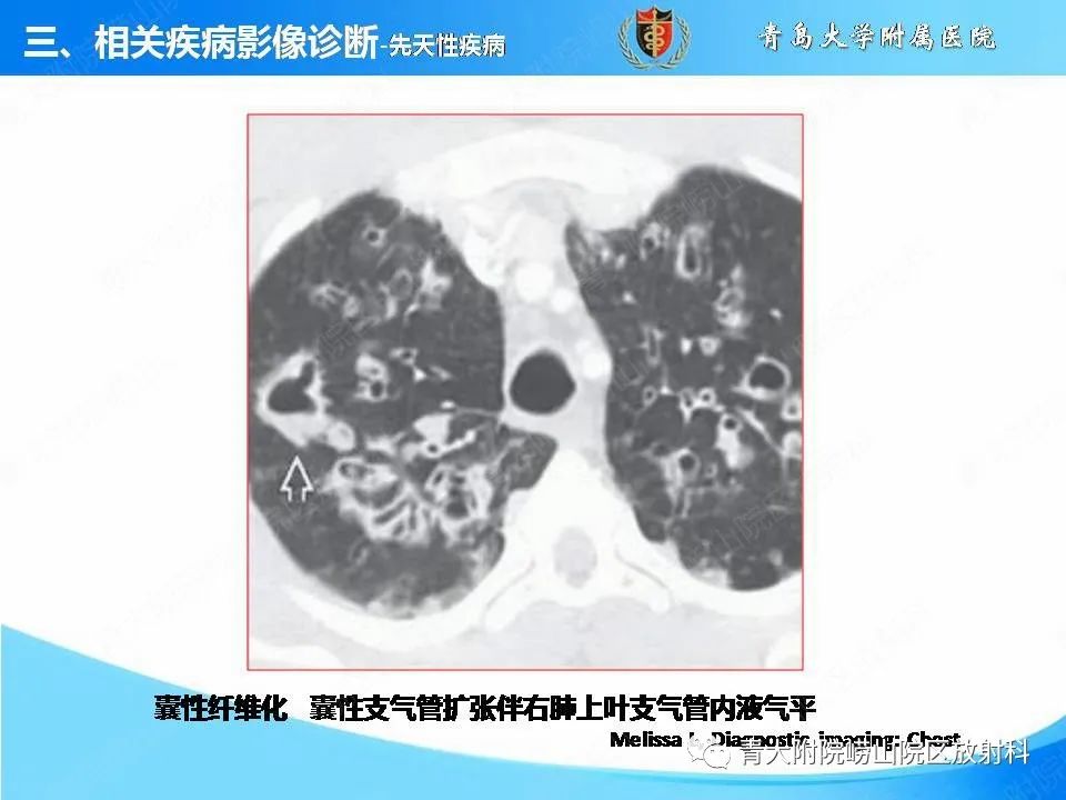 影像PPT - 【PPT】支气管黏液栓塞的影像诊断与鉴别-16