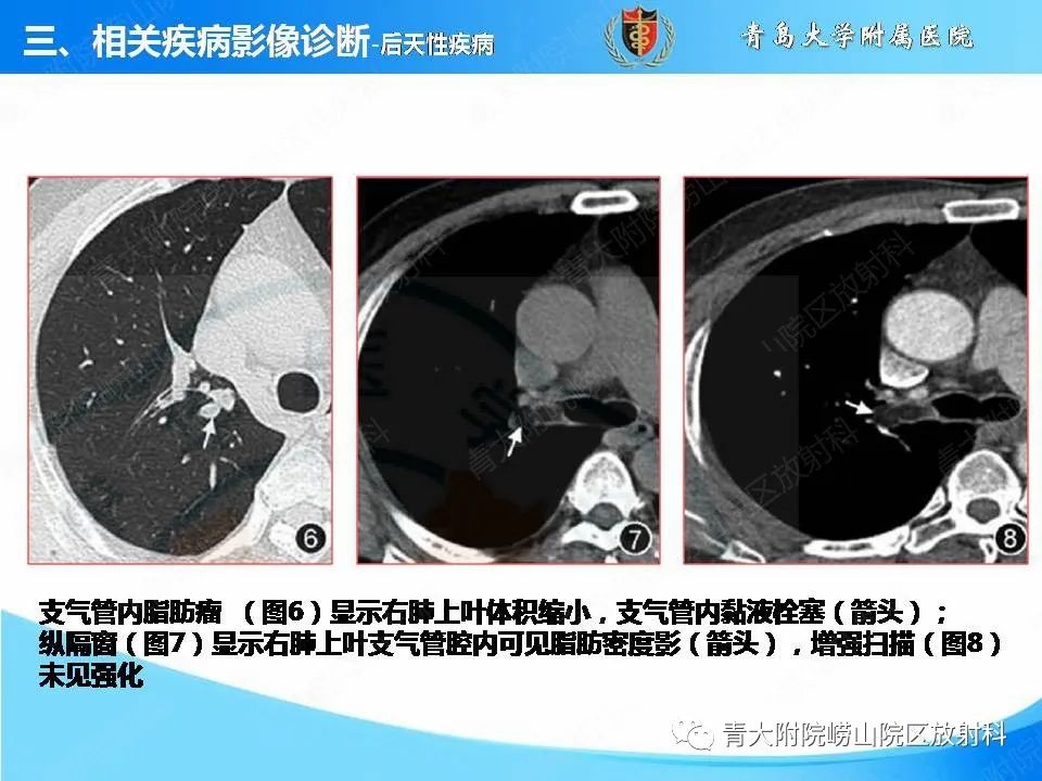 影像PPT - 【PPT】支气管黏液栓塞的影像诊断与鉴别-19