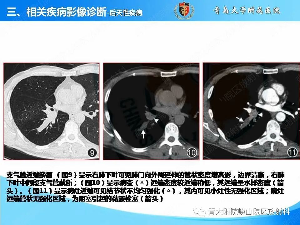 影像PPT - 【PPT】支气管黏液栓塞的影像诊断与鉴别-24