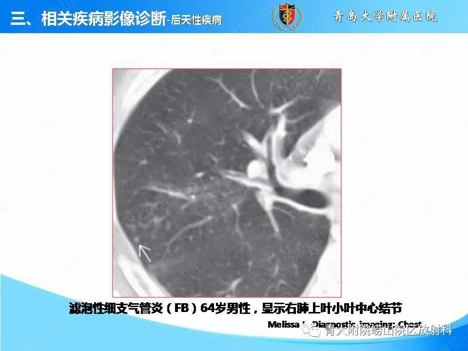 影像PPT - 【PPT】支气管黏液栓塞的影像诊断与鉴别-27