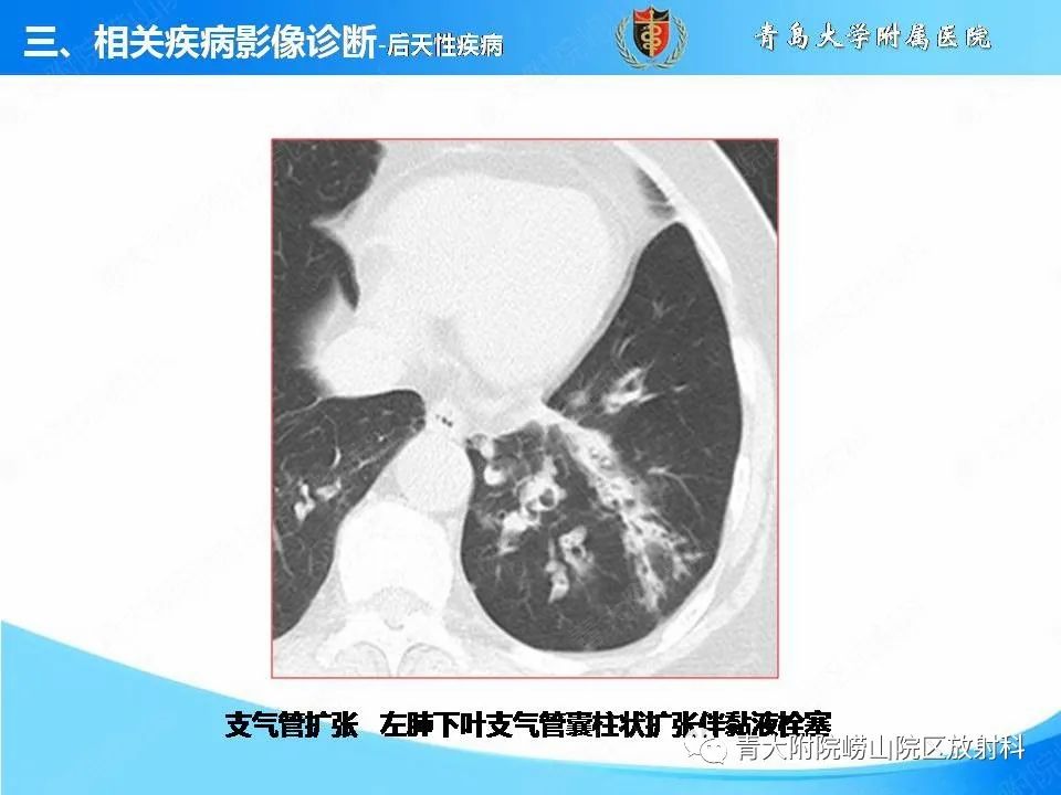 影像PPT - 【PPT】支气管黏液栓塞的影像诊断与鉴别-30