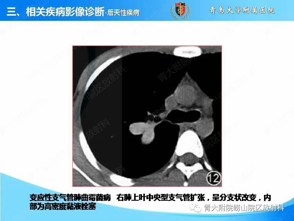 影像PPT - 【PPT】支气管黏液栓塞的影像诊断与鉴别-35